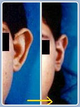 Ear reconstruction for prominent ear