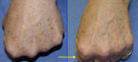brown spots on hands removed by laser