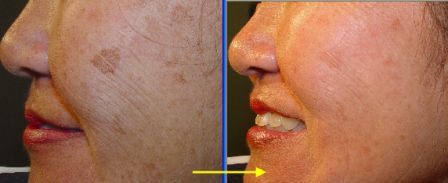 IPL laser to reduce brown spots