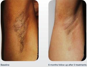 Laser Hair Removal Tokyo Japan Tattoo Removal Laser Mole Removal