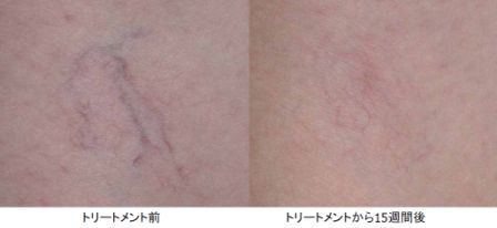vascular lesions removed by Yag laser