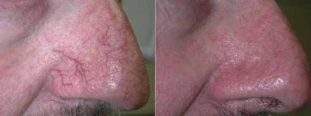 Rosacea removed by laser