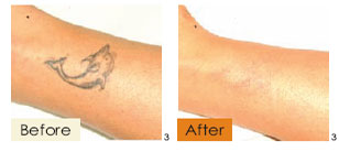 tattoo removal, example 2