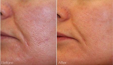 Genesis laser to reduce the skin pores)