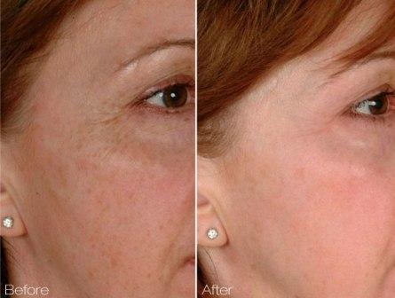 Laser Genesis for skin pores, tightening, fine wrinkles
