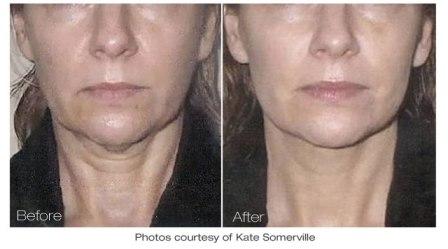 Facelift by Titan laser