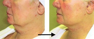 Underchin tightening by Titan laser