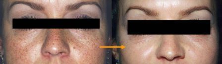 Removal of freckels by Q-switch laser