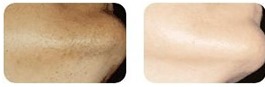 laser hair removal of chin