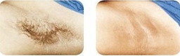 laser hair removal of underarm
