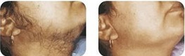 laser hair removal of face