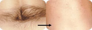 laser hair removal