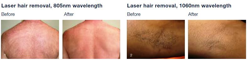 Laser Hair Removal Tokyo Japan Tattoo Removal Laser Mole Removal