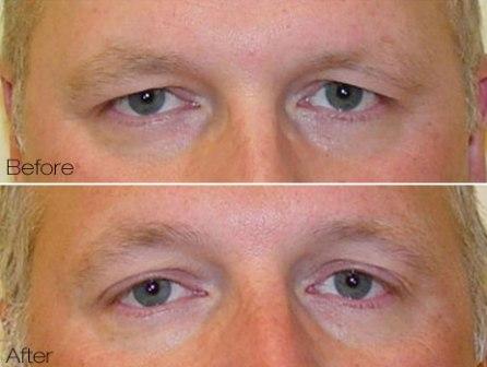Titan laser for tightening and lifting of brow
