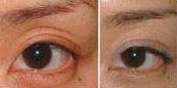 eyelid depression corrected by fat injection