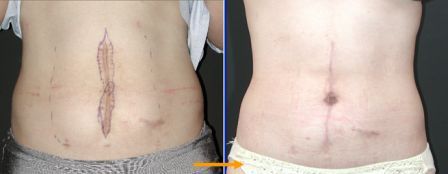 scar revision with tummy tuck