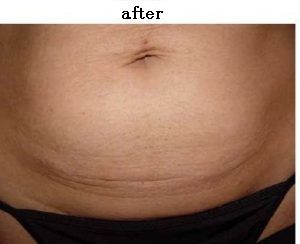 How To Tighten Skin After Pregnancy Without Surgery