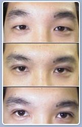 Asian Eyeld Surgery