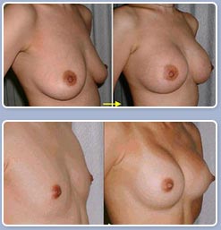 breast augmentation