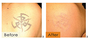 tattoo removal, example 1