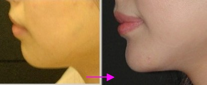 chin augmentation