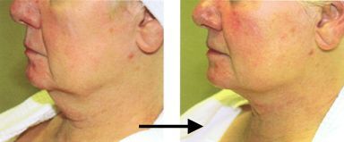 Titan laser is non-invasive to lift up unwanted sagging fat)