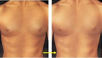 Gynecomastia - male breast growth