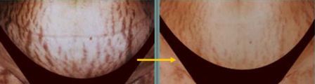 stretch mark treated with Yag and Titan Laser