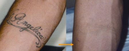 Q-swith laser to remove tattoo