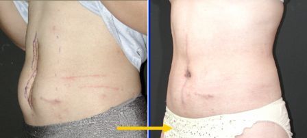 scar revision with tummy tuck